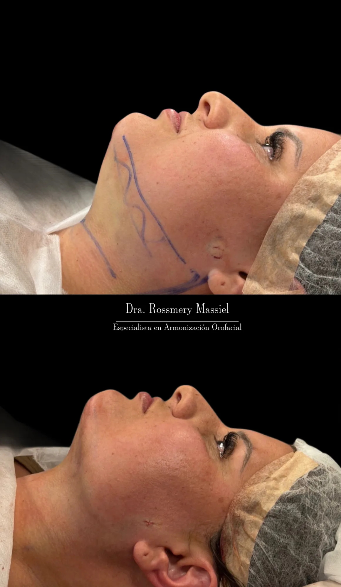 Fotografía clínica comparativa de lipopapada quirúrgica y contorno submentoniano