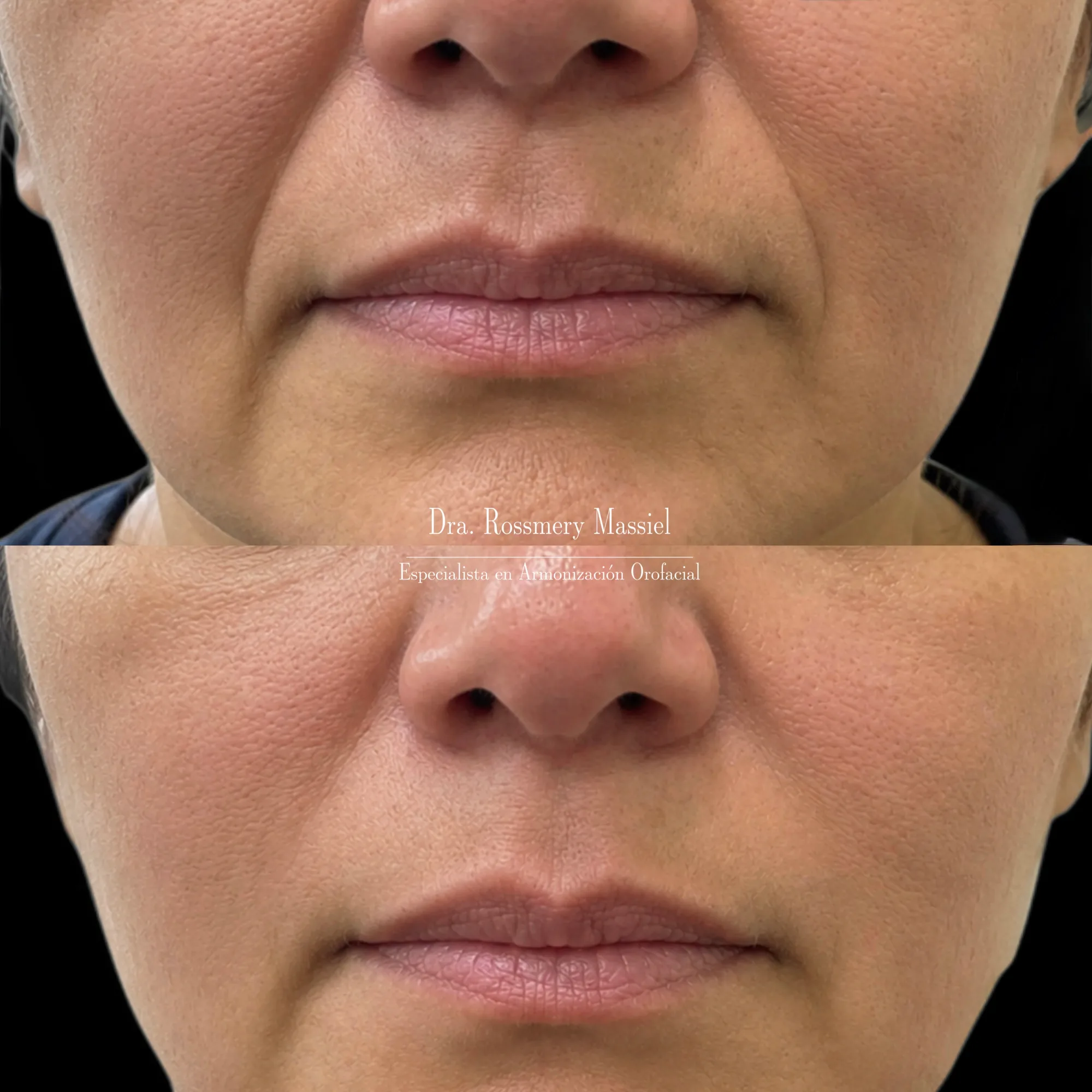Fotografía clínica comparativa del área perioral en una armonización facial