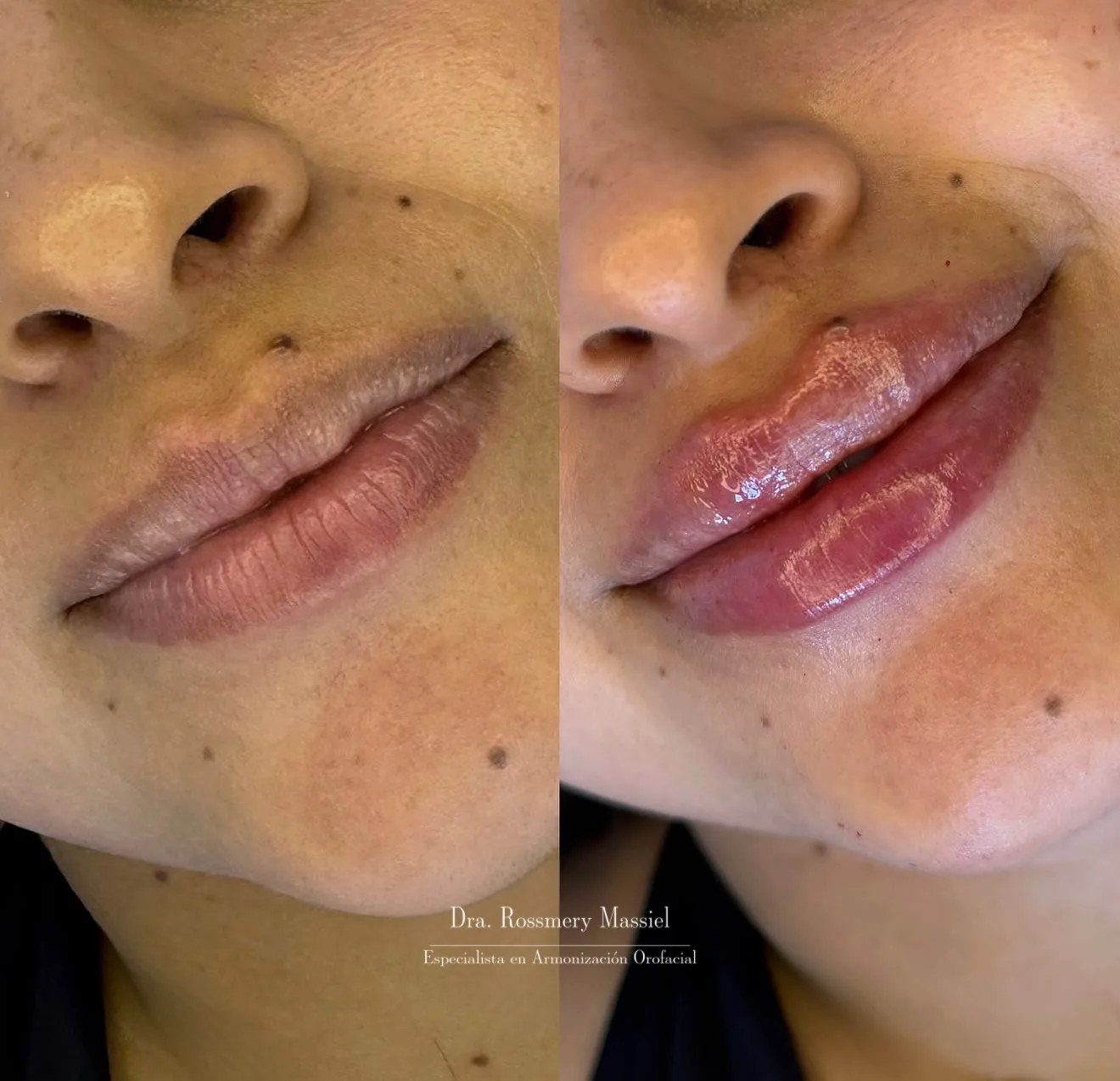 Fotografía clínica comparativa de definición labial