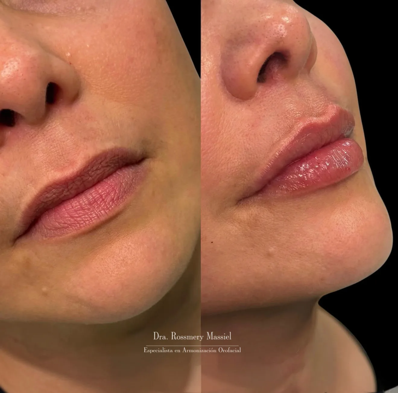 Fotografía clínica comparativa de proporción labial